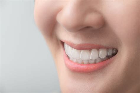 How Does 3d Scanning Help In Teeth Straightening Flash Aligners