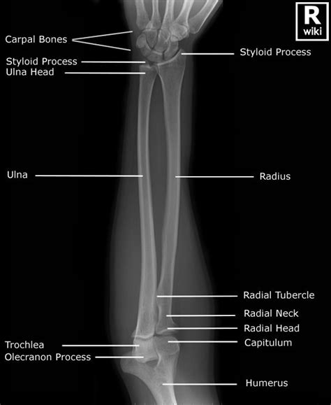 Forearm Radiographic Anatomy Wikiradiography Diagnostic Imaging