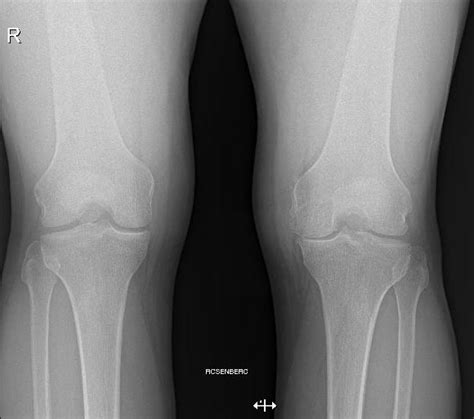 Unicompartmental Knee Arthroplasty In Patients Sixty Years