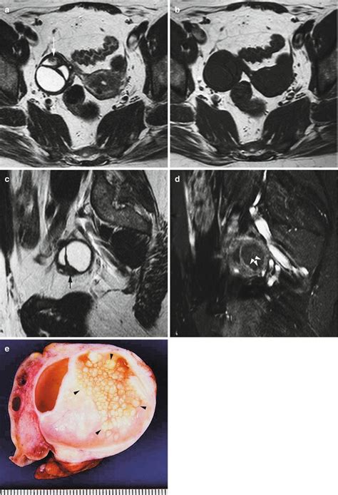 Adnexal Masses Benign Ovarian Lesions And Characterization Springerlink