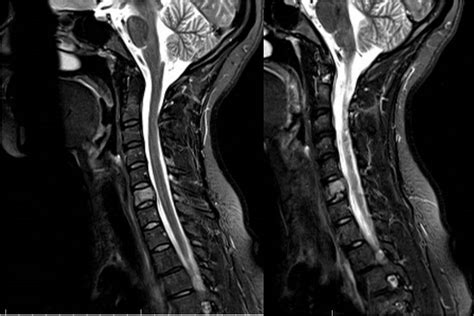 Cervical Spine Tumor Mri Of Neck Lelakion Mri Scans Pinterest