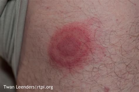 Lyme Disease Bullseye Rash