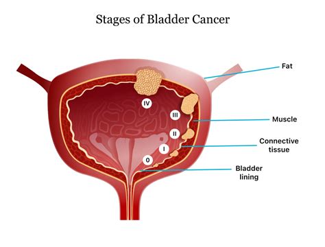 Guest Blog All You Need To Know About Bladder Cancer