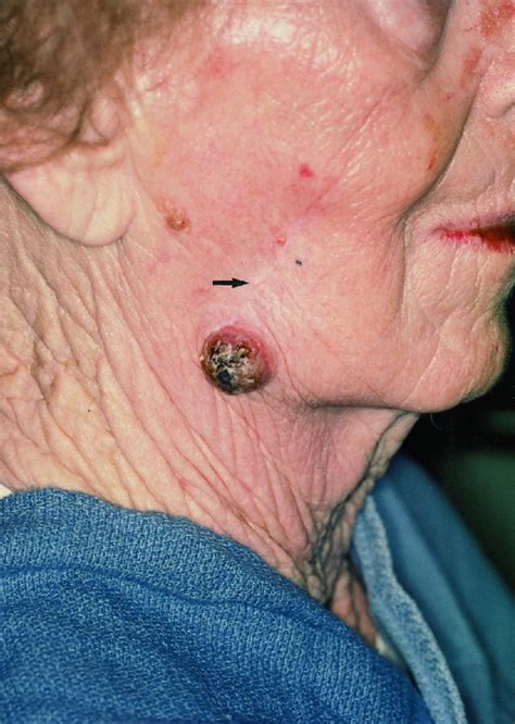 Reconstruction after surgery for skin cancer. Merkel cell carcinoma - Gollard - 2000 - Cancer - Wiley ...