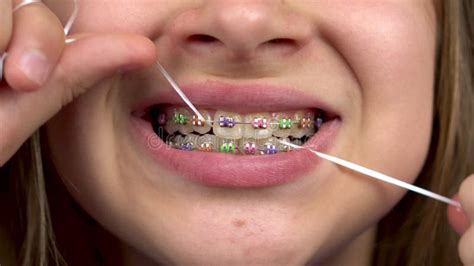 Teen Girl With Braces Smiling Close Up Girl With Colored Braces On Her Teeth Stock Footage