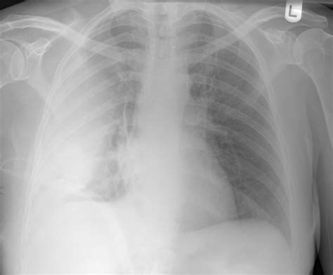 In transudative effusion, specific gravity is below 1.015 and. Pleural Space Infections/Empyema - Pulmonology Advisor