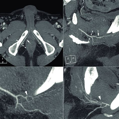 Pelvic Ct Angiography Showing The Penile Arteries A Three Dimensional