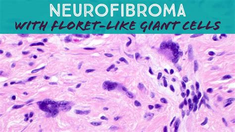 Neurofibroma With Floret Cells Dermpath Pathology Dermatology Youtube