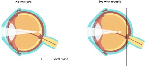 myopia short sightedness