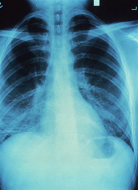 Different quantities are used to express dose. X-ray | Free Stock Photo | A chest x-ray | # 15332