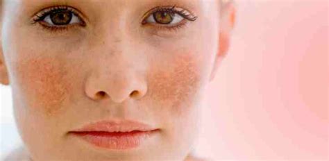 The Differences Between Scars Discoloration Melasma And How To