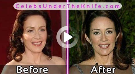 Patricia Heaton Plastic Surgery Pics Before After