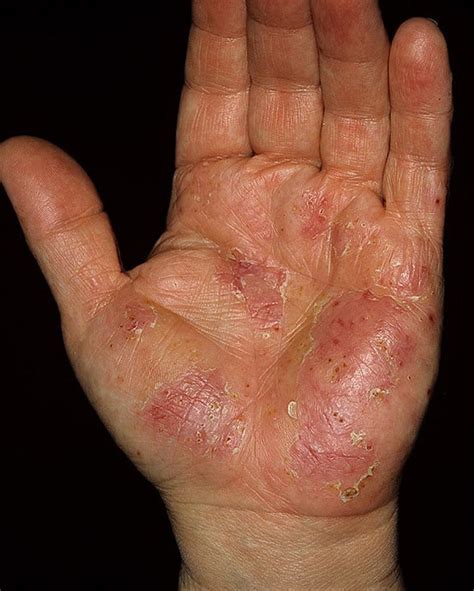 Eczema On Palm Of Hand Pictures