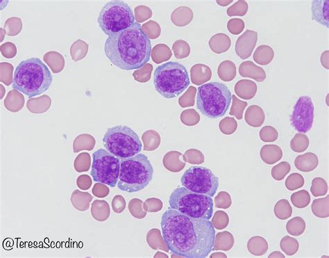 T Cell Lymphoma Blood Smear Leukemic Phase Of Alk Positive Anaplastic