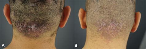 Papular Acne Keloidalis Nuchae Treatment Success Using Follicular Unit
