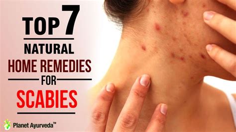 Top 7 Natural Home Remedies For Scabies This Skin Disease Is