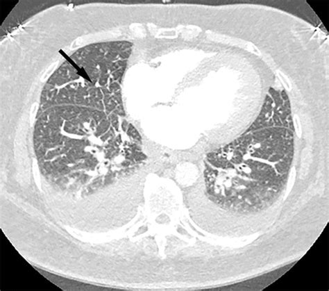 Review Of The Chest Ct Differential Diagnosis Of Ground Glass Opacities