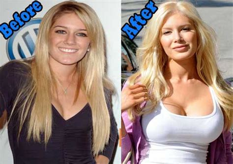 Heidi Montag Before And After Plastic Surgery