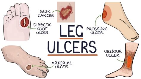 Understanding Leg And Foot Ulcers Youtube