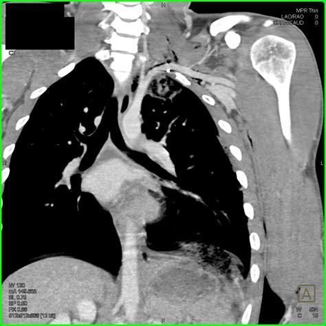 Gsw With Lung Bone And Muscle Injury Chest Case Studies Ctisus Ct