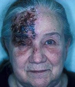 Symptoms of herpes (herpes symptoms), herpes infection, herpes dating and herpes dating tips. Shingles Newnan | Herpes Zoster Peachtree City | Elderly ...