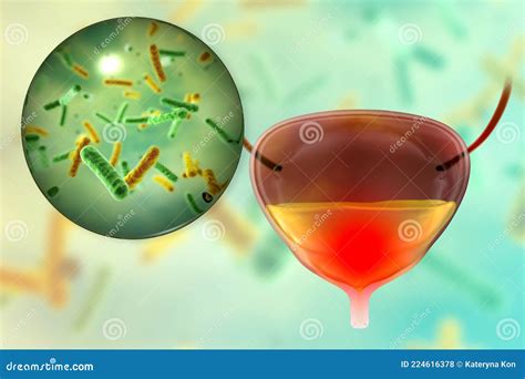 Cystitis Bacterial Infection Of Urinary Bladder Stock Illustration