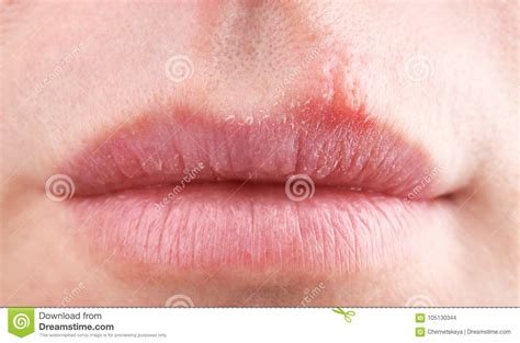 Herpes Blisters On Female Lips Stock Photo Image Of Immunity