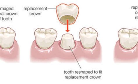 Dental Crown Procedure Explained Theme Loader