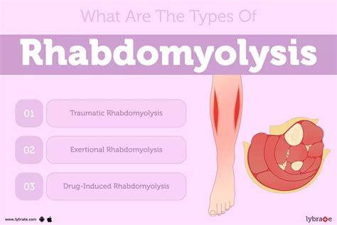 Rhabdomyolysis Causes Symptoms Treatment And Cost
