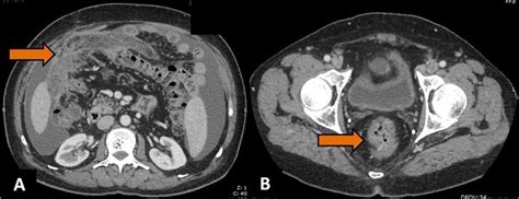 A Axial Contrast Enhanced Ct Scan Showing Omental Caking Arrowhead