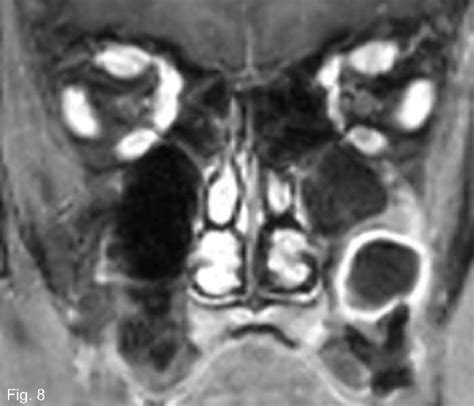 Mri Showing Peripheral Enhancement Of A Periapical Cyst Affecting The