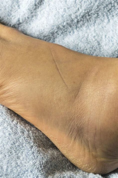Swollen Feet 15 Causes Treatments And Home Remedies