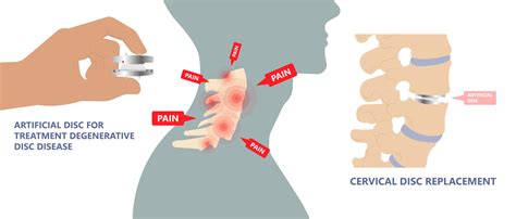 Artificial Cervical Disc Replacement Vs Anterior Cervical Discectomy