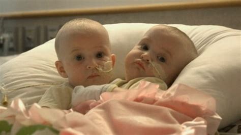 Conjoined Twin Girls Successfully Separated