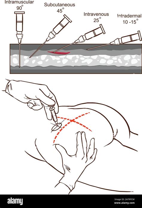 intramuscular injection vector illustration and comparison of the angles of intramuscular