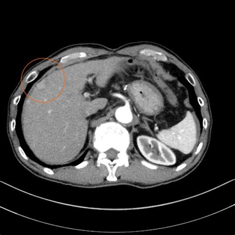 Abdominal Contrast Enhanced Computed Tomography And The Surgical