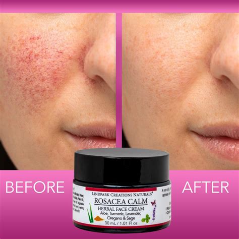 Rosacea Calm Face Treatment Cream Skin Specialist Naturopath