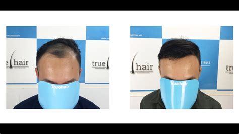 Free comprehensive online hair transplant consultation to accurately determine the best hair loss treatment plan for you. FUE Hair Transplant in Vietnam (2541 grafts) Truehair FUE ...