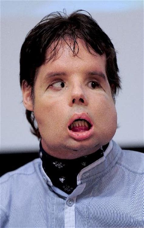 World First Full Face Transplant Man Makes First Public Appearance