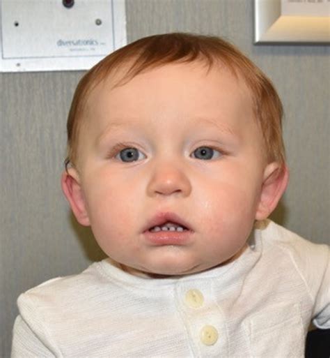 Cleft Lip And Palate Repair Before And After Photos By Rachel Ruotolo