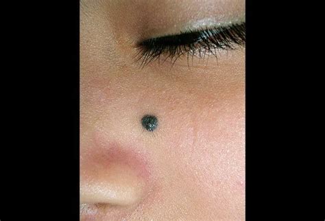 Blue Nevus Picture Image On