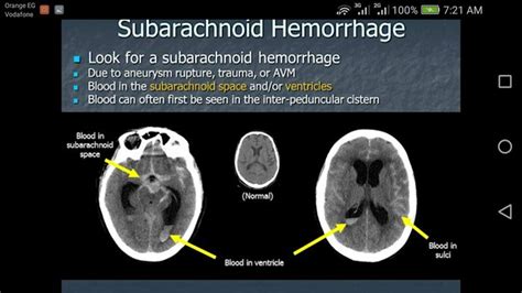 SubarChnoid Hge Radiology Imaging Subarachnoid Hemorrhage Hemorrhage