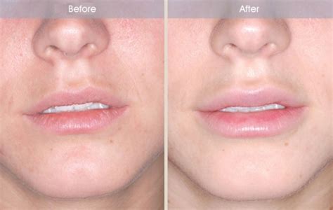 The Variation Of Side Effects Of Juvederm In Lips Hannah Toby