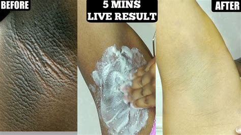 In 5 Minutes Lighten Dark Underarms Naturally And Permanently Youtube