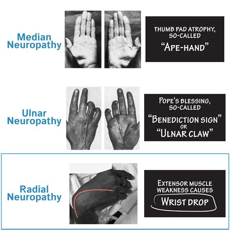 Neuroanatomy Glossary Radial Neuropathy Ditki Medical And Biological
