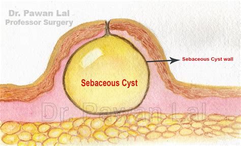 Sebaceous Cysts Of Scrotum