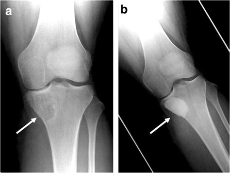 Radiographs Showing Cmf Of The Tibia With Postoperative Appearances