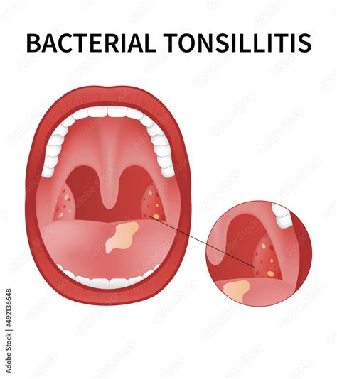 Fototapeta Bacterial And Viral Tonsillitis Angina Pharyngitis And