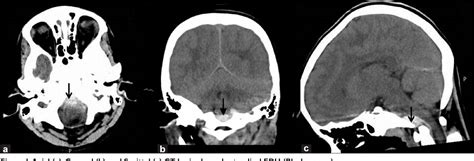 Figure 1 From Traumatic Retroclival Epidural Hematoma In Pediatric