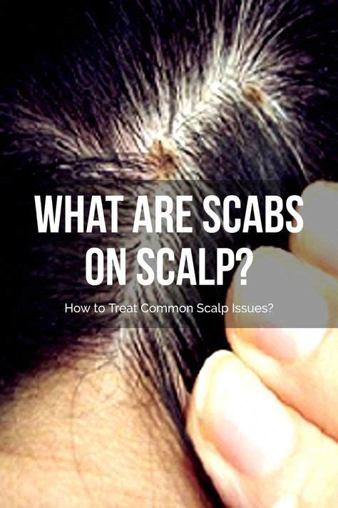 What Are Scabs On Scalp How To Treat Common Scalp Issues